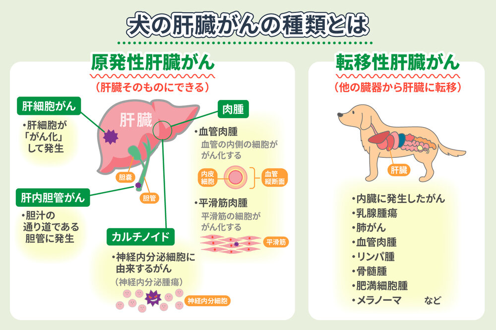 肝臓がんの種類